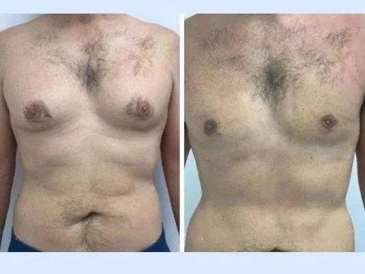 Best Gynecomastia Surgeons in Dubai: Delivering Balanced, Masculine, and Symmetrical Chests