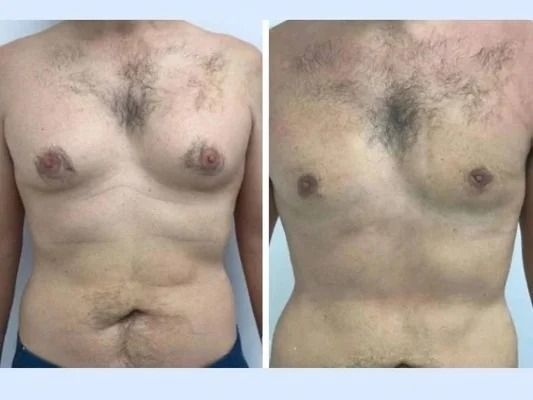 Gynecomastia in Dubai