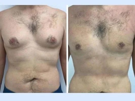 Best Gynecomastia Surgeon in Dubai: Choosing the Right Time for Male Breast Reduction Surgery